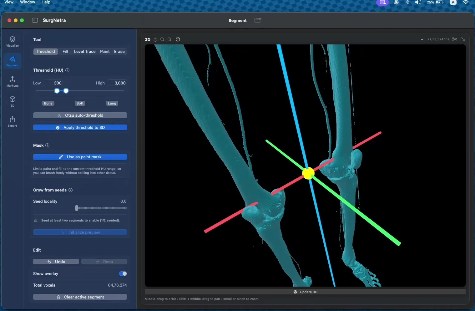 Three-dimensional bone reconstruction with coloured measurement axes overlaid