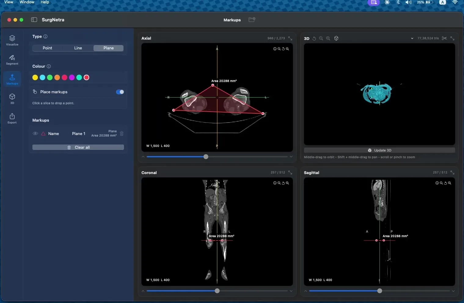 Markup tool palette with coloured annotation overlaid on a CT slice and 3D view